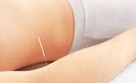 Dry Needling